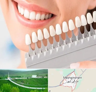 متخصص لمینت دندان در مشگین شهر