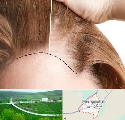 کاشت مو برای خانمها در مشگین شهر