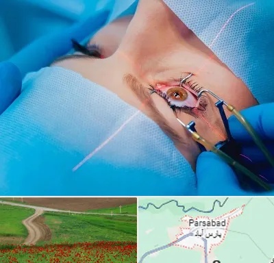 عمل prk چشم در پارس آباد