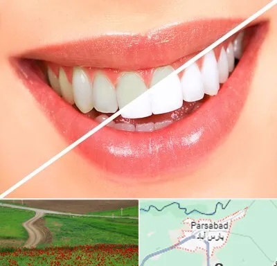 بلیچینگ دندان در پارس آباد