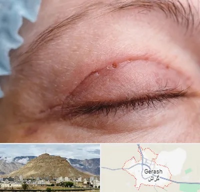 جراح پلک در گراش