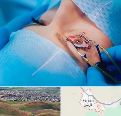 عمل prk چشم در فارسان