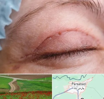 جراح پلک در پارس آباد
