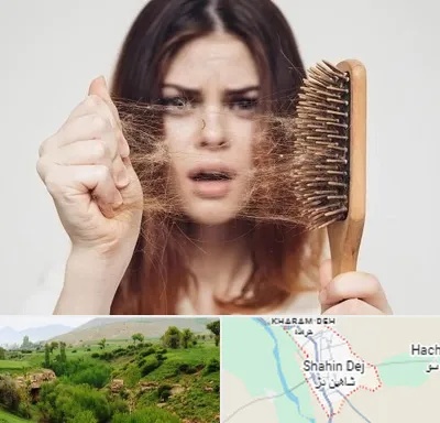 دکتر ریزش مو در شاهین دژ