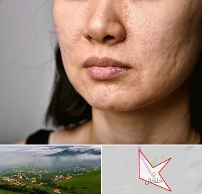 سابسیژن جای جوش در خلخال