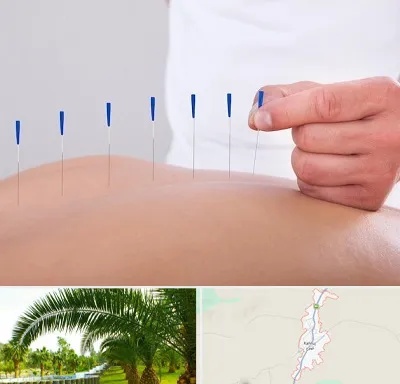 دکتر طب سوزنی در کهنوج