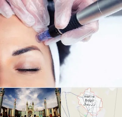 کلینیک مزوتراپی صورت در آران و بیدگل
