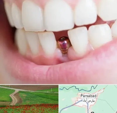 ایمپلنت اقساطی در پارس آباد
