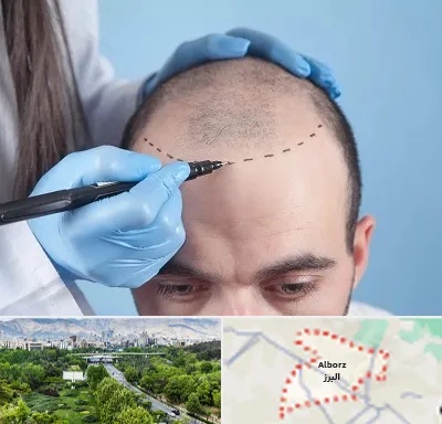 کاشت مو اقساطی در البرز