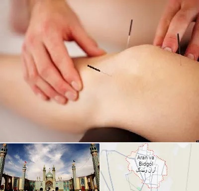 دکتر طب سوزنی برای لاغری در آران و بیدگل