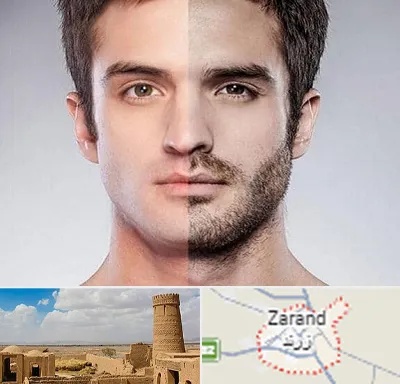 کاشت ریش و سبیل در زرند