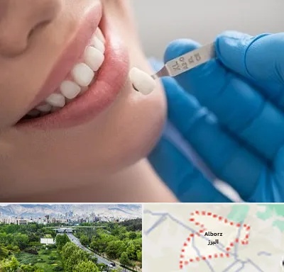 مرکز لمینت دندان در البرز