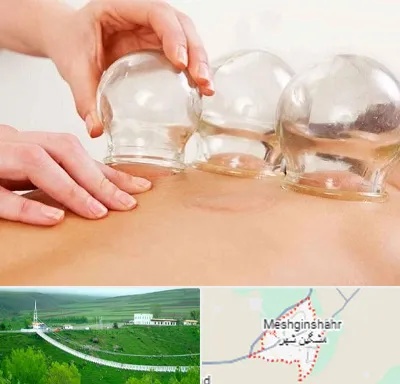 بادکش درمانی در مشگین شهر