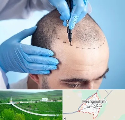 دکتر کاشت مو در مشگین شهر