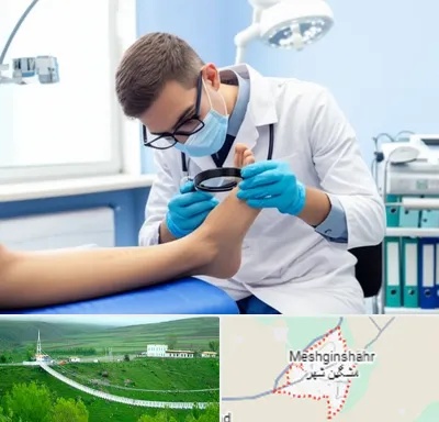 درمان زخم پای دیابتی در مشگین شهر