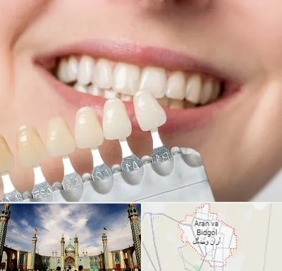 مرکز کامپوزیت دندان در آران و بیدگل