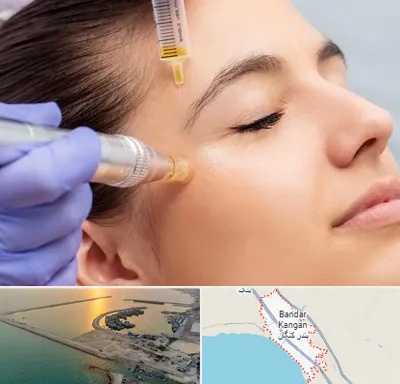 میکرونیدلینگ در بندر کنگان