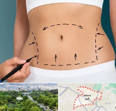 عمل ابدومینوپلاستی در البرز