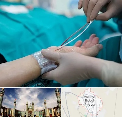 آنژیوگرافی در آران و بیدگل