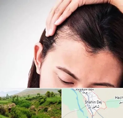 کاشت مو بانوان در شاهین دژ