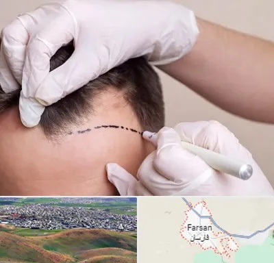 کاشت مو به روش SUT در فارسان