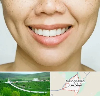 عمل چال گونه در مشگین شهر