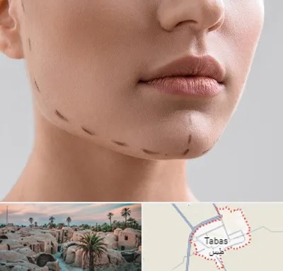 عمل زاویه فک در طبس
