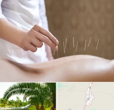 درای نیدلینگ در کهنوج