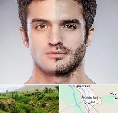 کاشت ریش و سبیل در شاهین دژ