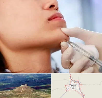 زاویه سازی صورت در تکاب