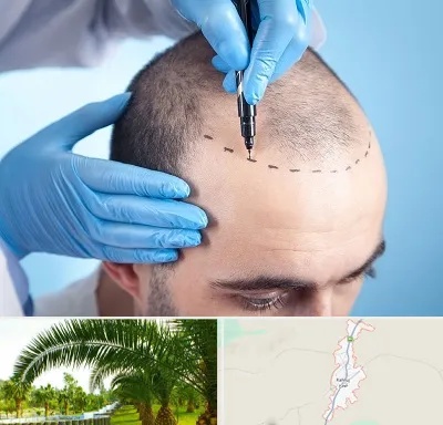 دکتر کاشت مو در کهنوج
