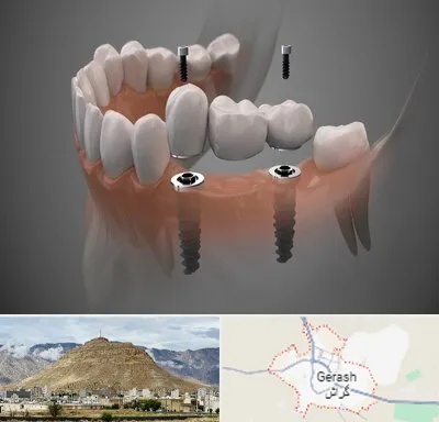 ایمپلنت دیجیتال در گراش