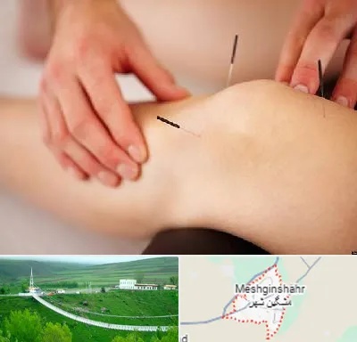 دکتر طب سوزنی برای لاغری در مشگین شهر