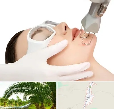 لیزر فرکشنال در کهنوج