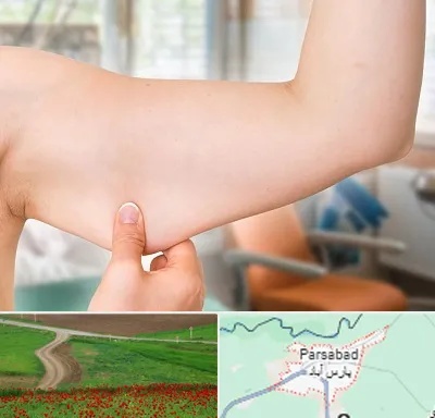 براکیوپلاستی در پارس آباد