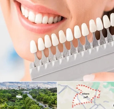 متخصص لمینت دندان در البرز