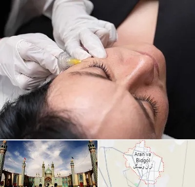 کربوکسی تراپی در آران و بیدگل
