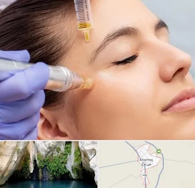 میکرونیدلینگ در خورموج