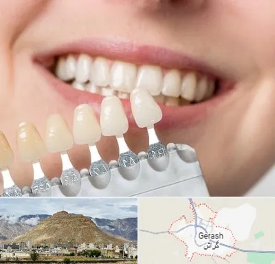 مرکز کامپوزیت دندان در گراش