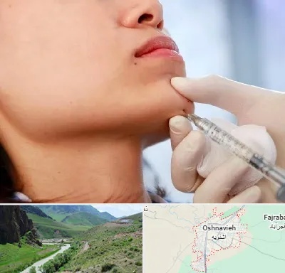 زاویه سازی صورت در اشنویه