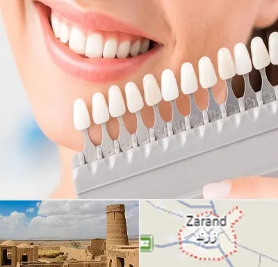متخصص لمینت دندان در زرند