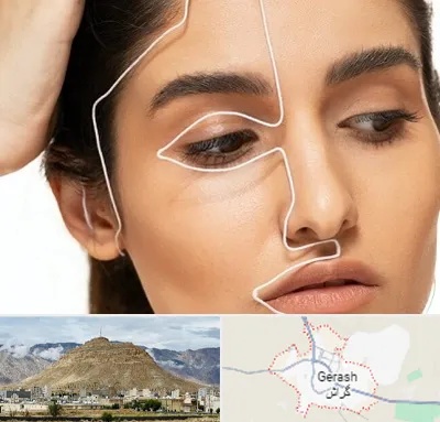 عمل بینی اقساطی در گراش