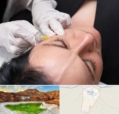 کربوکسی تراپی در گرمسار