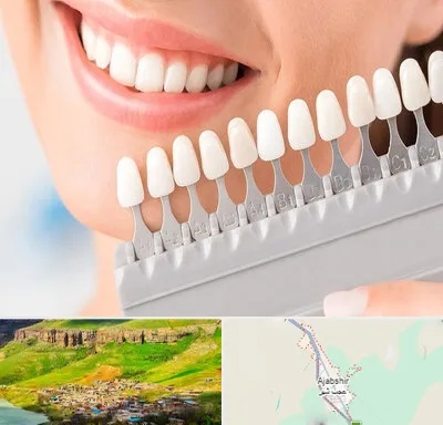 متخصص لمینت دندان در عجب شیر