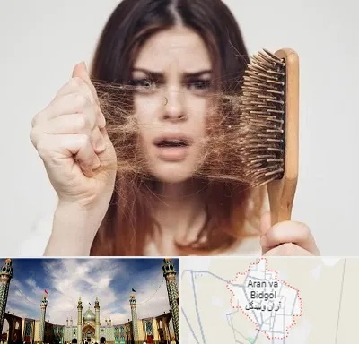 دکتر ریزش مو در آران و بیدگل