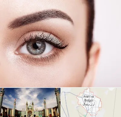 فوق تخصص عنبیه در آران و بیدگل