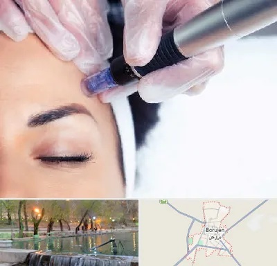 کلینیک مزوتراپی صورت در بروجن