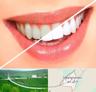 بلیچینگ دندان در مشگین شهر