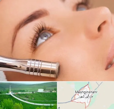 میکرودرم در مشگین شهر