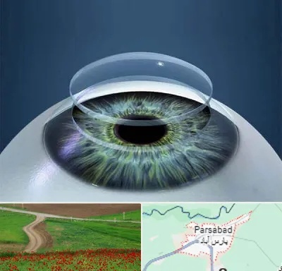 پیوند قرنیه در پارس آباد
